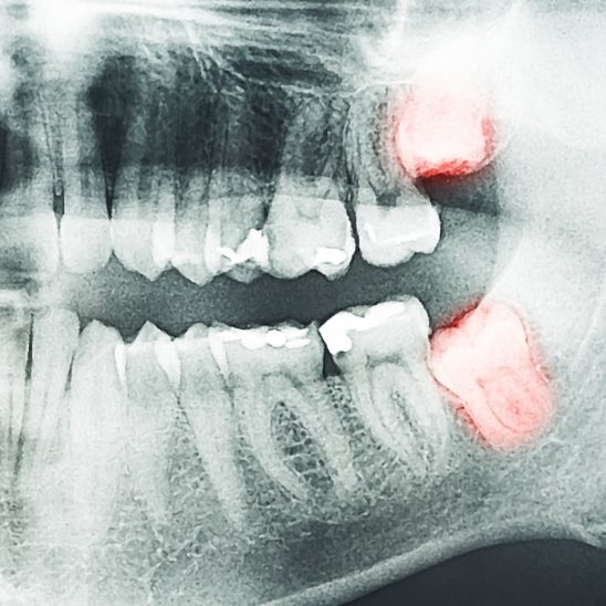Extractions dentaires : seulement si nécessaires 