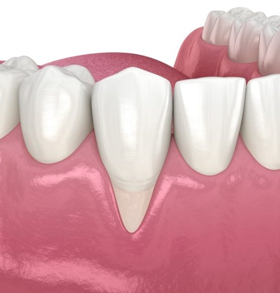 Qu’est-ce que la récession gingivale, la raison pour laquelle on procède aux greffes de gencives ? 
