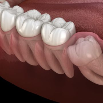 Les dents de sagesse en 3 questions